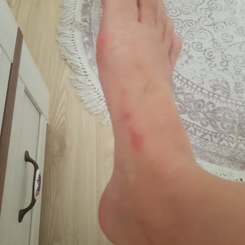 Greyder Kadın Terliği 15 Dakikada Ayak Kesip Yara Bıraktı