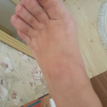 Greyder Kadın Terliği 15 Dakikada Ayak Kesip Yara Bıraktı