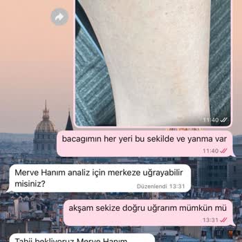 Ciddi Lazer Epilasyon Yanığı Ve İade Talebi