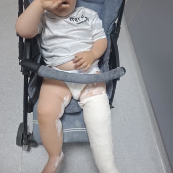 Çocukta Kırık Gözden Kaçırıldı, Hastane İhmaline Karşı Maddi Ve Manevi Şikayet