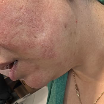 Sinoz Vitamin C Serumu Ciltte Yanma Ve Lekelere Neden Oldu, Ücret İadesi Ve Tazminat Talebi