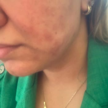 Sinoz Vitamin C Serumu Ciltte Yanma Ve Lekelere Neden Oldu, Ücret İadesi Ve Tazminat Talebi