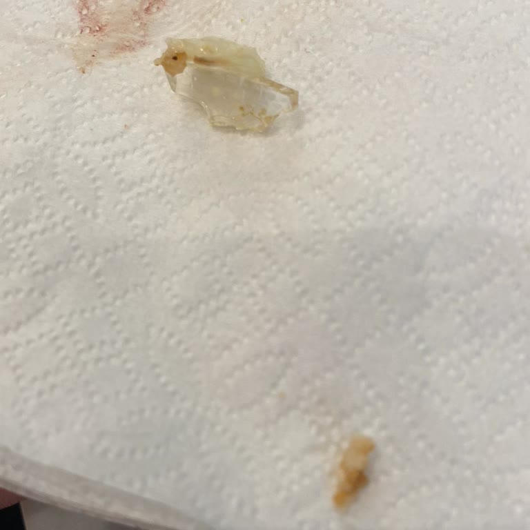 İzmir Karşıyaka Burger King’de Plastik Parça Nedeniyle Diş Kırılması Ve Yetersiz Telafi