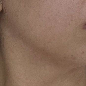 Bi'Clinic | Gaziantep Cildimde Oluşan Lekeler