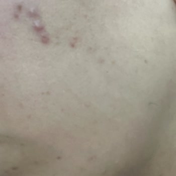 Bi'Clinic | Gaziantep Cildimde Oluşan Lekeler