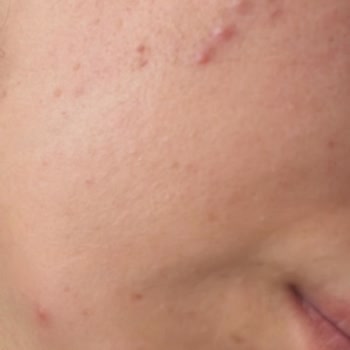 Bi'Clinic | Gaziantep Cildimde Oluşan Lekeler