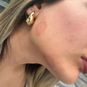Buz Lazer Epilasyonunda Yanık Ve Mantar Enfeksiyonu: İade Ve Tedavi Masrafları Talebi