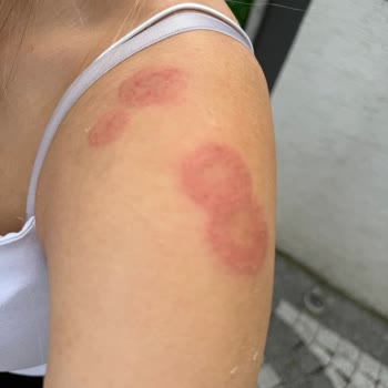 Buz Lazer Epilasyonunda Yanık Ve Mantar Enfeksiyonu: İade Ve Tedavi Masrafları Talebi