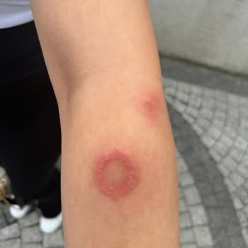 Buz Lazer Epilasyonunda Yanık Ve Mantar Enfeksiyonu: İade Ve Tedavi Masrafları Talebi