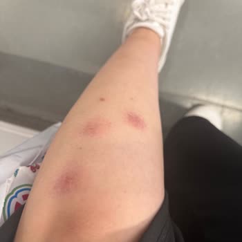 Buz Lazer Epilasyonunda Yanık Ve Mantar Enfeksiyonu: İade Ve Tedavi Masrafları Talebi