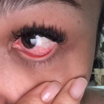 Gizem Doğan Beauty | Ataköy İpek Kirpik Uygulaması Sonrası Göz Enfeksiyonu Ve Cevapsızlık