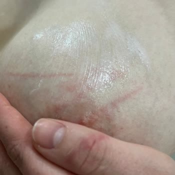 Zeer Lux Beauty Lounge Şubesinde Uygunsuz Buz Lazer Uygulaması Ve Haksız Ek Ücret Talebi