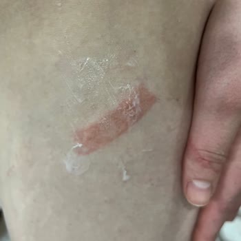 Zeer Lux Beauty Lounge Şubesinde Uygunsuz Buz Lazer Uygulaması Ve Haksız Ek Ücret Talebi