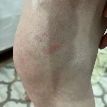Zeer Lux Beauty Lounge Şubesinde Uygunsuz Buz Lazer Uygulaması Ve Haksız Ek Ücret Talebi