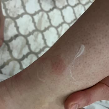 Zeer Lux Beauty Lounge Şubesinde Uygunsuz Buz Lazer Uygulaması Ve Haksız Ek Ücret Talebi