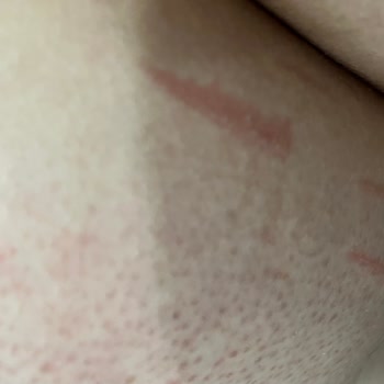 Zeer Lux Beauty Lounge Şubesinde Uygunsuz Buz Lazer Uygulaması Ve Haksız Ek Ücret Talebi