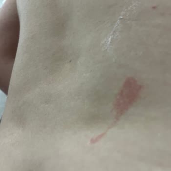 Zeer Lux Beauty Lounge Şubesinde Uygunsuz Buz Lazer Uygulaması Ve Haksız Ek Ücret Talebi