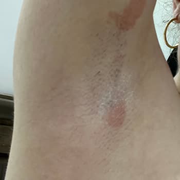 Zeer Lux Beauty Lounge Şubesinde Uygunsuz Buz Lazer Uygulaması Ve Haksız Ek Ücret Talebi