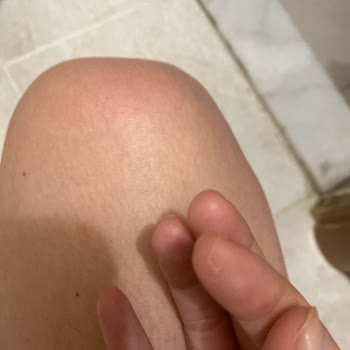 Sensodyne Tam Beyazlatıcı Diş Macunu Kullanımında Şiddetli Ağız Tahrişi Ve Soyulma