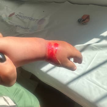 Bebek Çay Dökülmesi Sonrası Yanık: Otel Sorumluluğu Ve Tazminat Talebi
