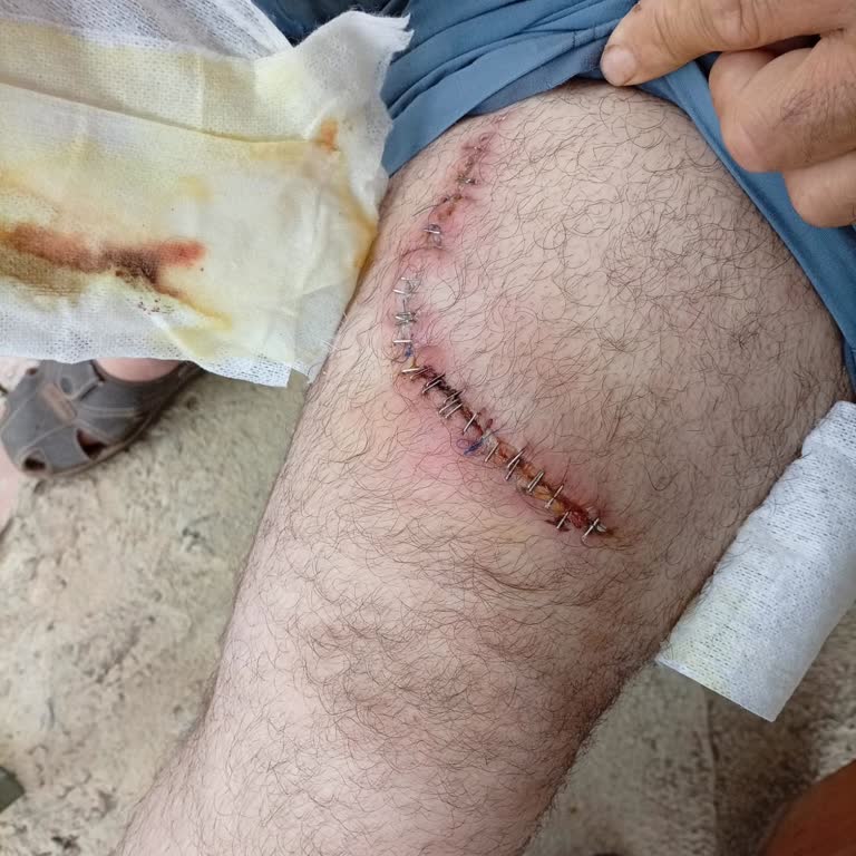 28 Dikişle Sonuçlanan İş Kazası Sonrası Tazminat Ve Güvenlik İncelemesi Talebi