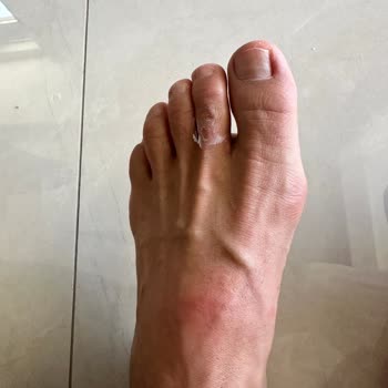 Hepsiburada Crocs Terlikte Kısa Sürede Ayak Yarası Ve İade Talebi