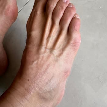 Hepsiburada Crocs Terlikte Kısa Sürede Ayak Yarası Ve İade Talebi