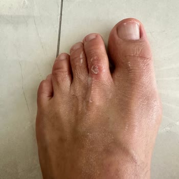 Hepsiburada Crocs Terlikte Kısa Sürede Ayak Yarası Ve İade Talebi