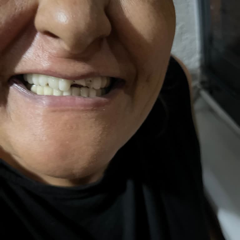 Tekrarlayan Implant Kırıkları Ve Hastane Tavrı Nedeniyle Ücret İadesi Talebi