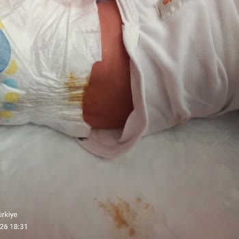 Molfix Bezlerinde Kaka Sızdırma Sorunu Bebeğimi Rahatsız Ediyor