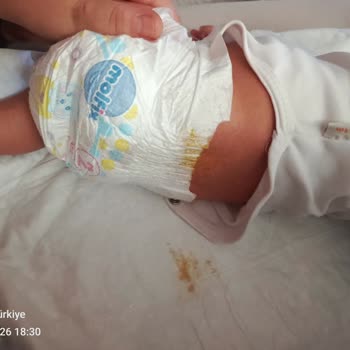 Molfix Bezlerinde Kaka Sızdırma Sorunu Bebeğimi Rahatsız Ediyor