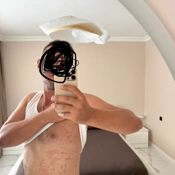 Veet Hassas Cilt Tüy Dökücü Kremi Kullanımından Şiddetli Alerjik Reaksiyon Ve Tatil İptali