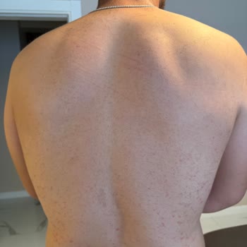 Veet Hassas Cilt Tüy Dökücü Kremi Kullanımından Şiddetli Alerjik Reaksiyon Ve Tatil İptali