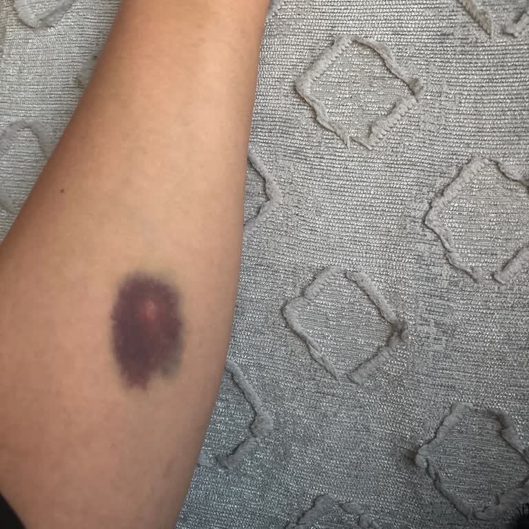 Acil Serviste Hassas Hastanın Uyarısına Rağmen Yanma Ve Morluk