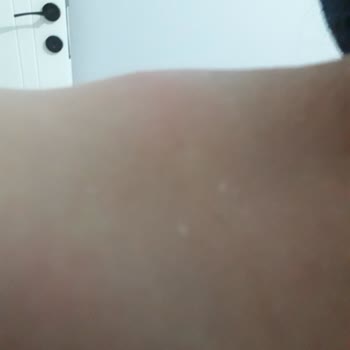 YHT Yolculuğumda Böcek Isırığı Ve Hijyen İlaçlamasında Acil Çözüm Gerekiyor