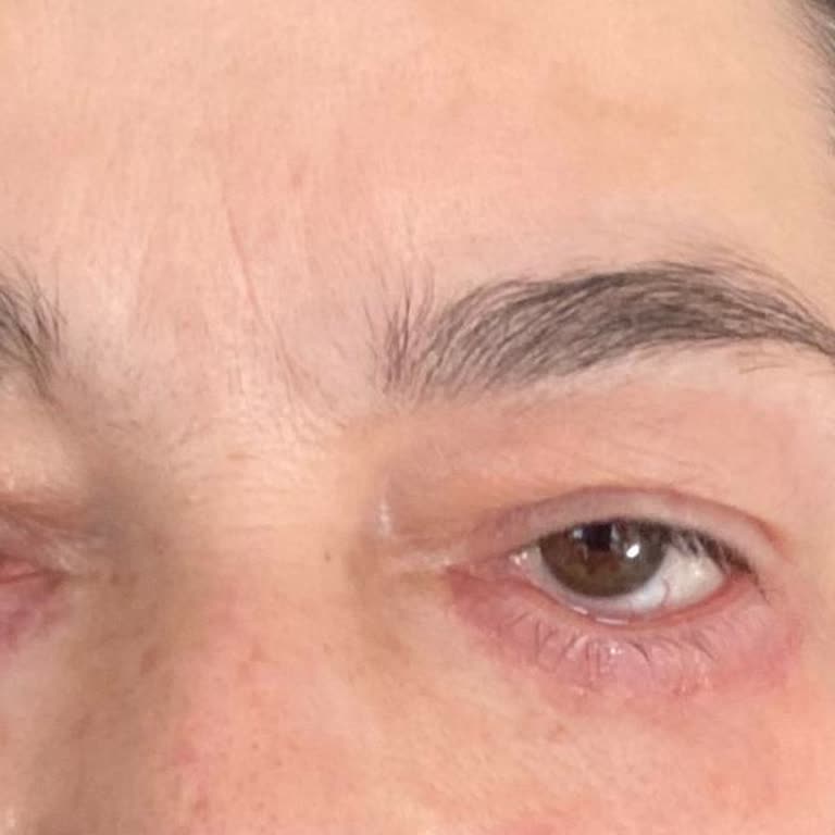 İstenmeyen Göz Kapağı Düşmesi Ve Geniş Kesi Hattı Nedeniyle Estetik Mağduriyet