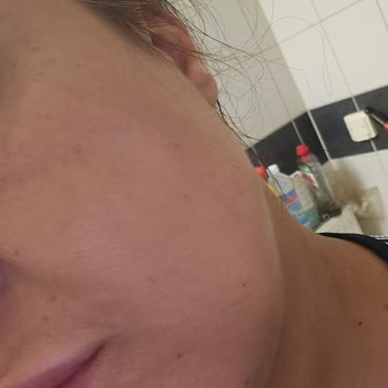 Yanıltıcı Bilgi Ve Eksik Uygulama İle Kalitesiz Dudak Dolgusu Şikayetim
