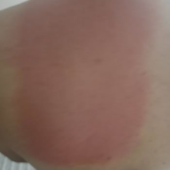 Şanlı Isıtıcı Bandı Engelli Kullanıcıda Aşırı Yanma Ve Cilt Tahrişi Yaratıyor
