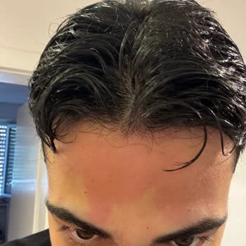 Hautreizung Nach Seba-Med Anti-Haarverlust Shampoo