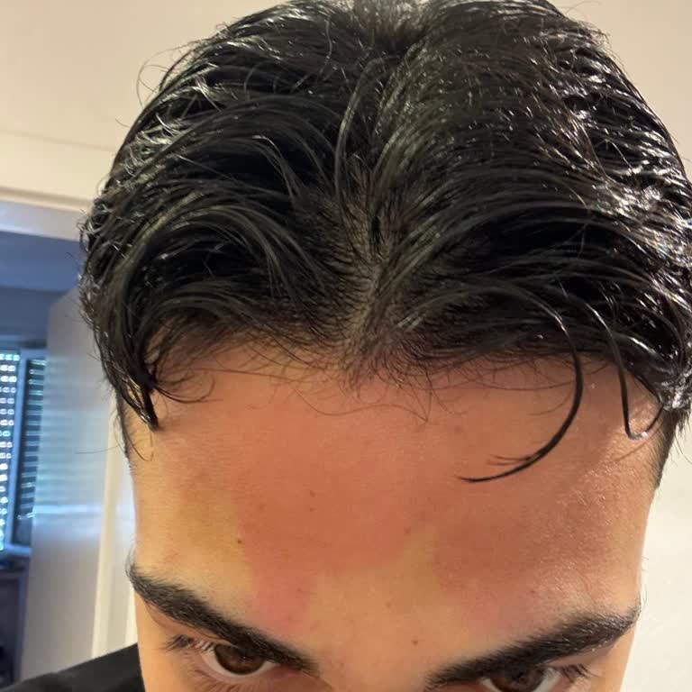 Hautreizung Nach Seba-Med Anti-Haarverlust Shampoo