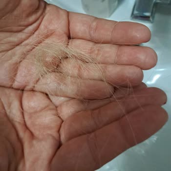 Kaynak Saç Uygulamasında Hızlı Saç Dökülmesi Ve 13.000 TL Ücret İadesi Talebi