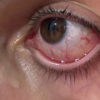 Bebek Şampuanı Gözde Şiddetli Yanma Ve Ağrı Şikayeti