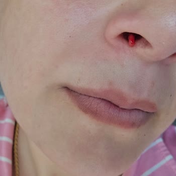 Burun Ameliyatı Sonrası Nefes Alma Zorluğu Ve Doktorun Engellemesi
