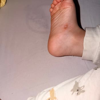 Ortopedik Sandalet Çocuğumda Tahrişe Neden Oldu, İade Reddi