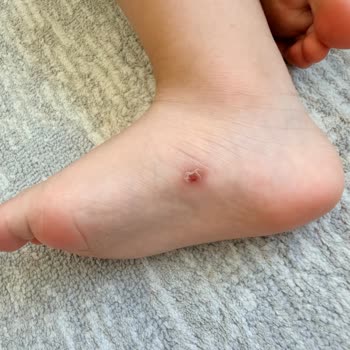 Ortopedik Sandalet Çocuğumda Tahrişe Neden Oldu, İade Reddi
