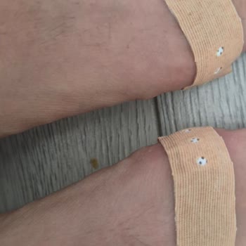 Boyner'den Aldığım Ayakkabı Mezuniyet Gecesinde Ayağımı Yanık Duruma Sürükledi
