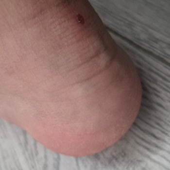 Boyner'den Aldığım Ayakkabı Mezuniyet Gecesinde Ayağımı Yanık Duruma Sürükledi