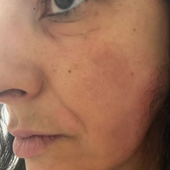 Estée Lauder Revitalizing Supreme+ Kreminde Şiddetli Cilt Reaksiyonu Ve Orijinallik Şüphesi