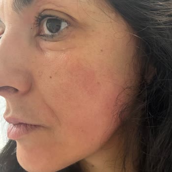 Estée Lauder Revitalizing Supreme+ Kreminde Şiddetli Cilt Reaksiyonu Ve Orijinallik Şüphesi