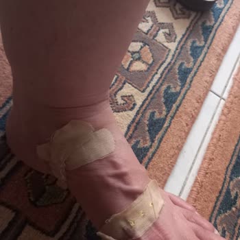 Ayak Kesici Terlik İçin İade Reddi Ve Sağlık Şikayeti
